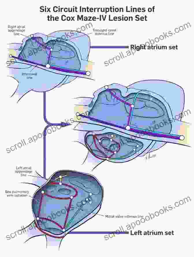 Diagram Of The Convergent Ex Maze Procedure For Atrial Fibrillation My Convergent Ex Maze Procedure For Atrial Fibrillation: One Patient S Detailed Account Of His Experience