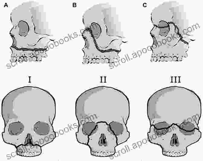 Step By Step Surgical Images Demonstrate The Nuances Of Craniofacial Trauma Management. Mathog S Atlas Of Craniofacial Trauma